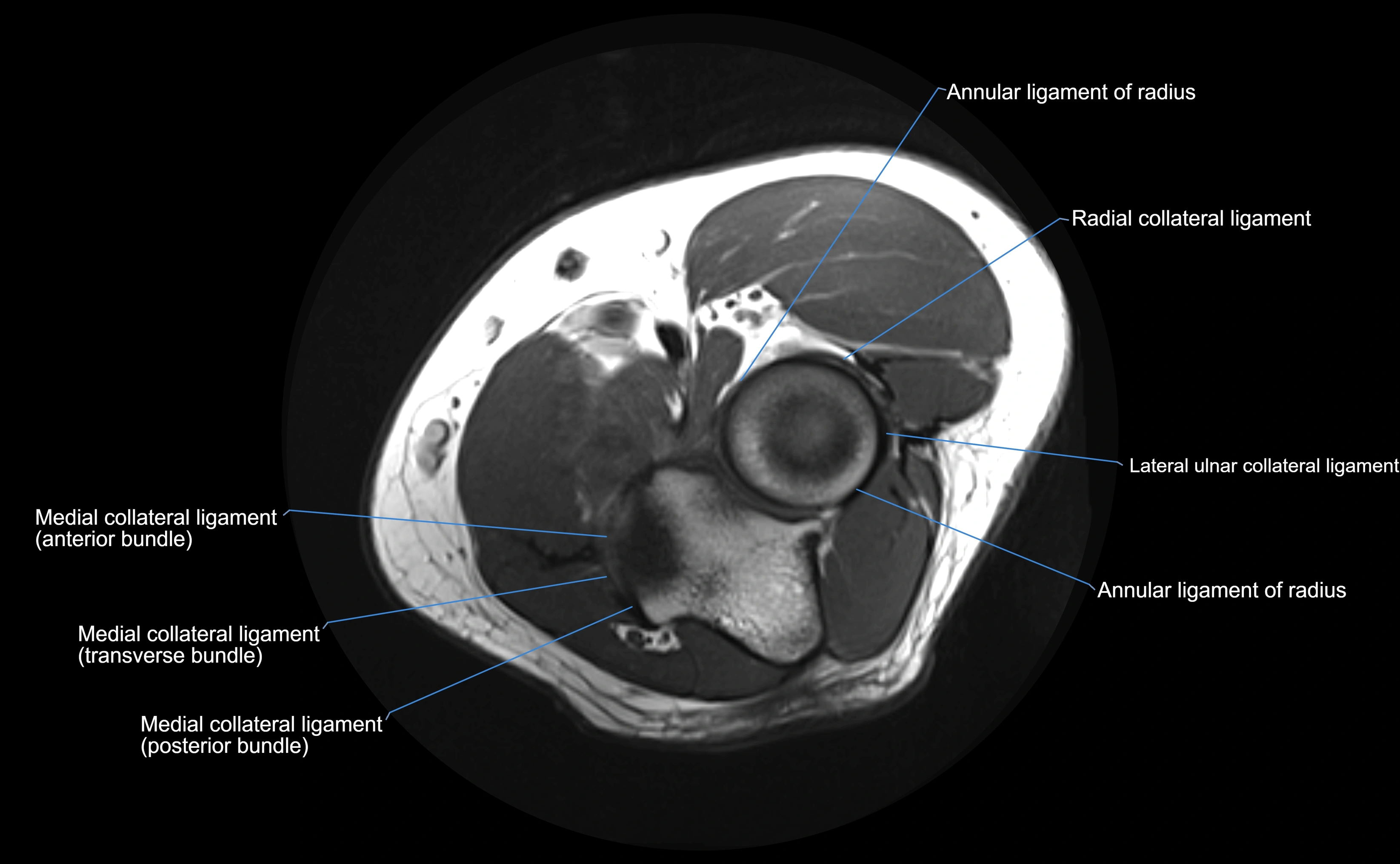 MRI elbow ligaments axial cross sectional anatomy 3T  radiology  image-img-00001-00017.webp